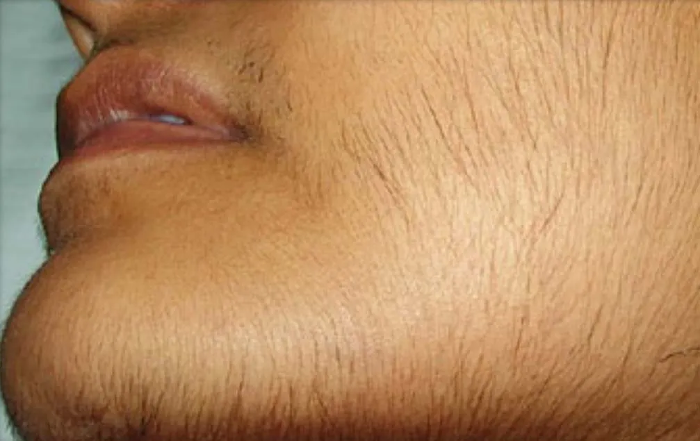 महिलाओं में अनचाहे बाल का कारण है Hirsutism