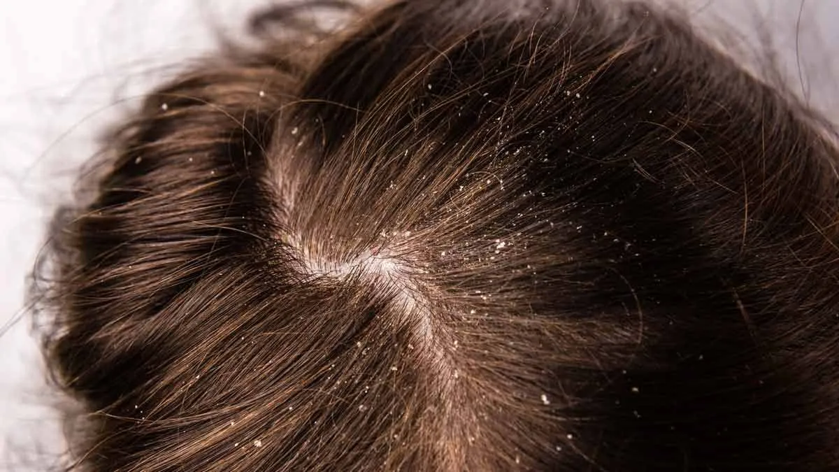 Dandruff  से इस प्रकार बचाव कर सकती हैं आप